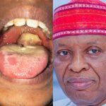 Kano dieases