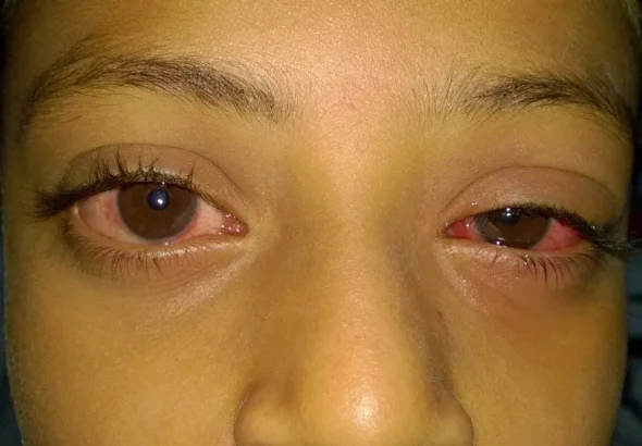 hemorrhagic-conjunctivitis-popularly-known-as-Apollo