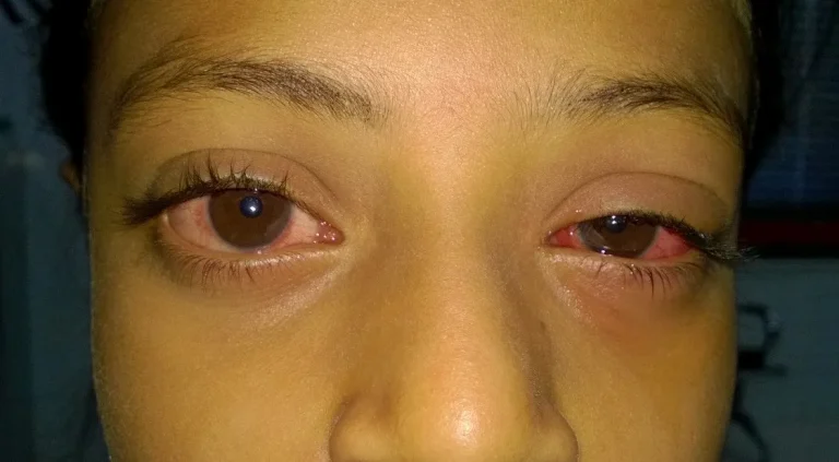 hemorrhagic-conjunctivitis-popularly-known-as-Apollo