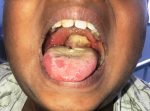 Diphtheria-patient