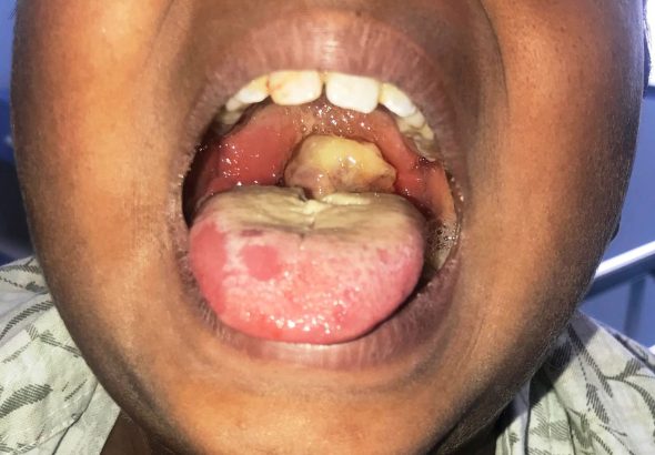 Diphtheria-patient