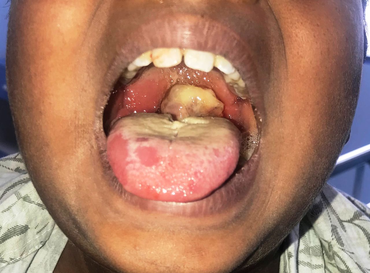 Diphtheria-patient