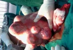 Fibroid-768x528