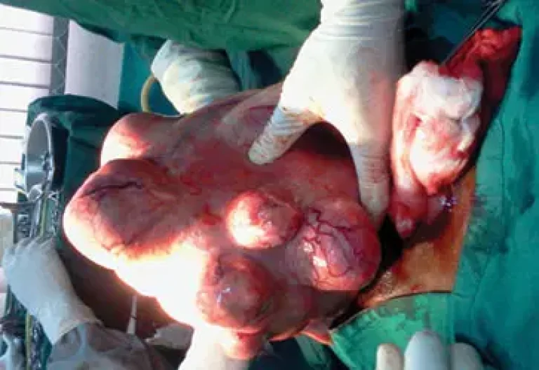 Fibroid-768x528