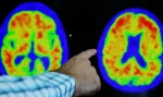 Alzheimer
