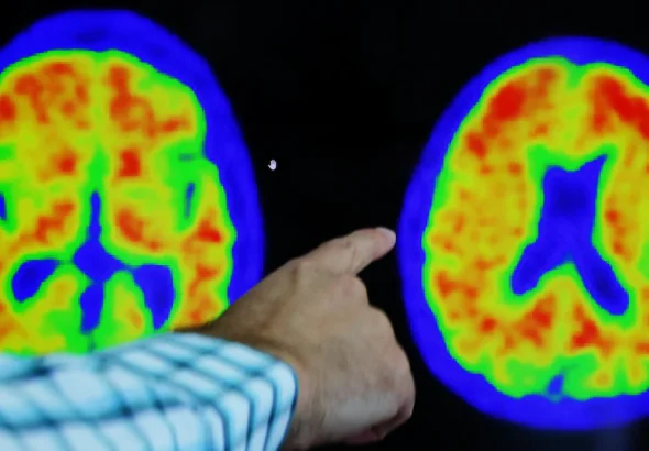 Alzheimer