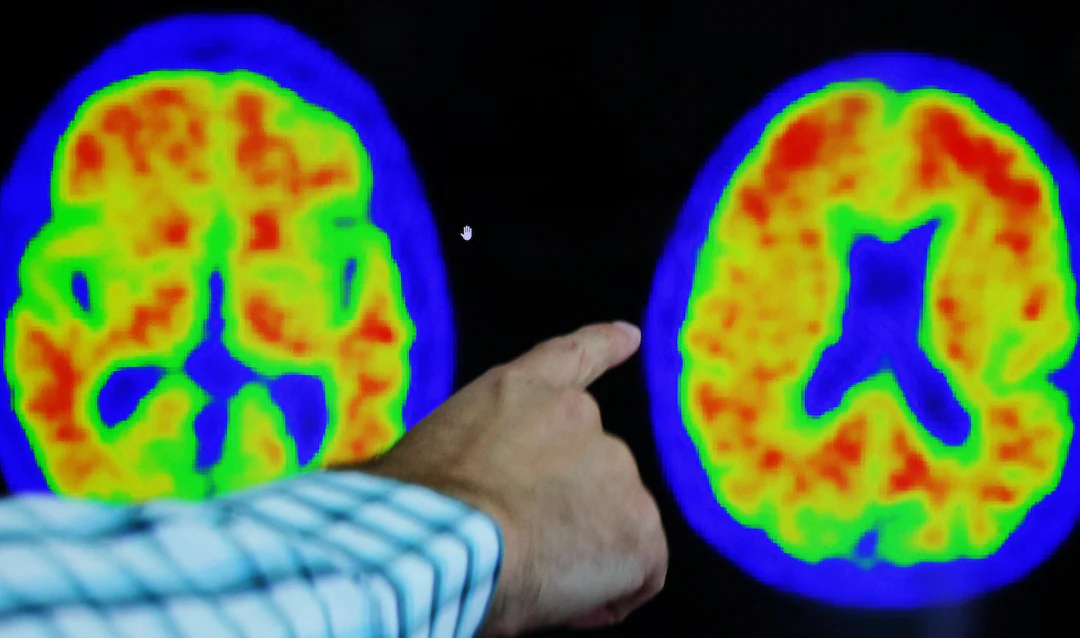 Alzheimer